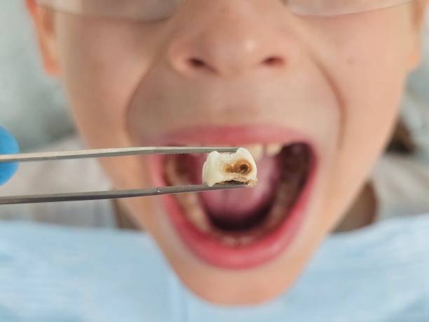 Best Emergency Dental Care for Broken or Chipped Teeth in La Porte, IN